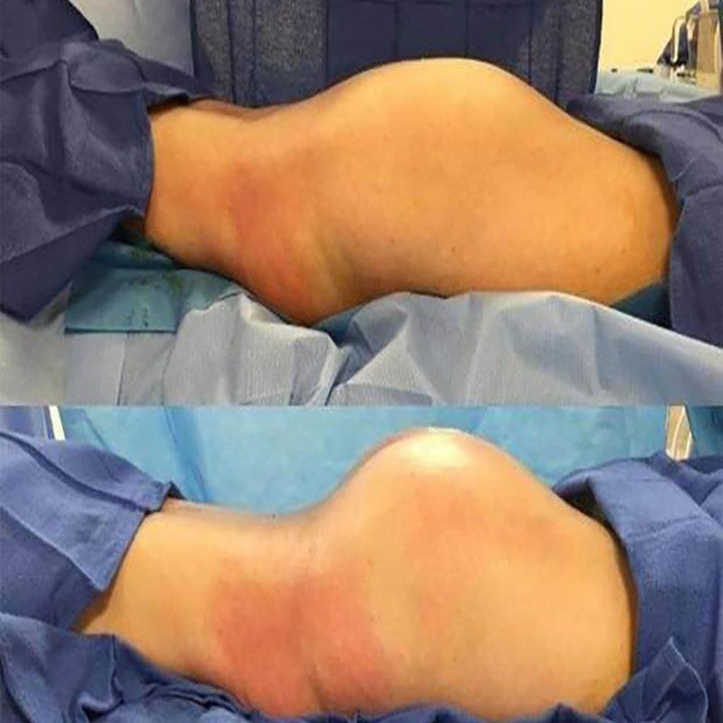 لیفتینگ بدن لیپوساکشن