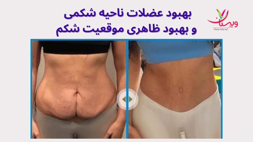 تراکم پوستی ناحیه شکم بهبود موقعیت و تناسب شکم