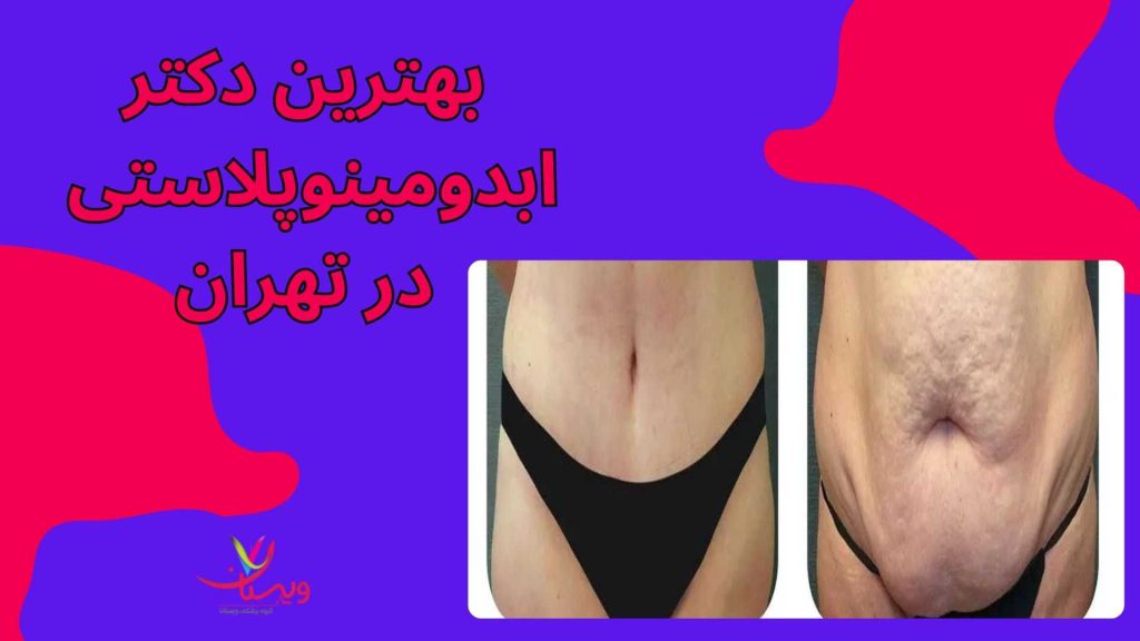 دکتر آرش جهانشاهی ابدومینوپلاستی