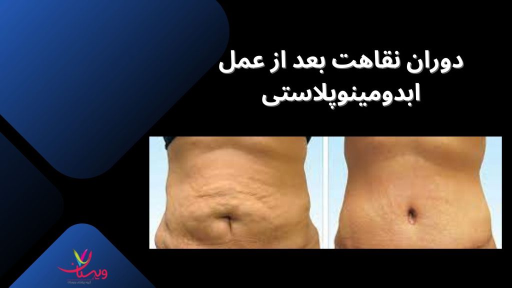 جراحی لیفت شکم