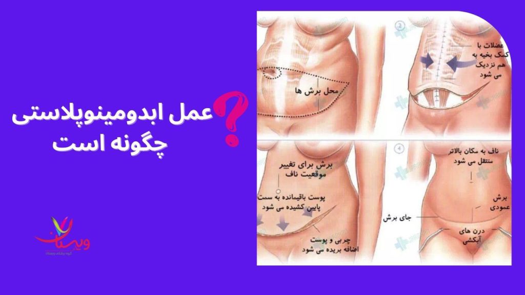 عمل ابدومینوپلاستی عمل جراحی زیبایی