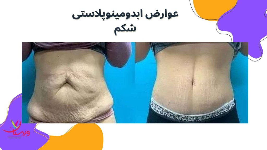 تشکیل بافت تغییرات در حس پوستی منطقه شکم