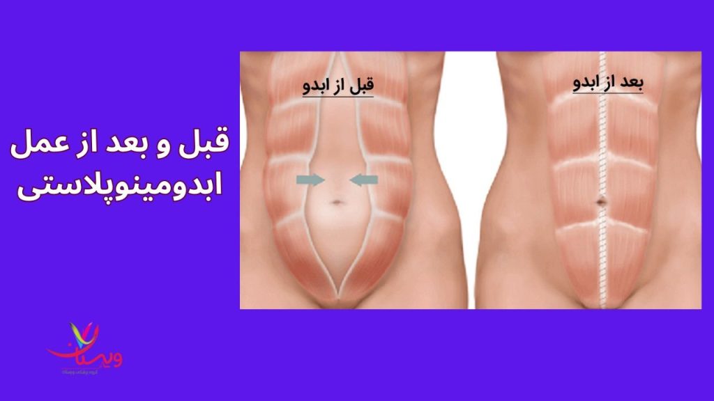 تعویض بندهای زخم عمل ابدومینوپلاستی