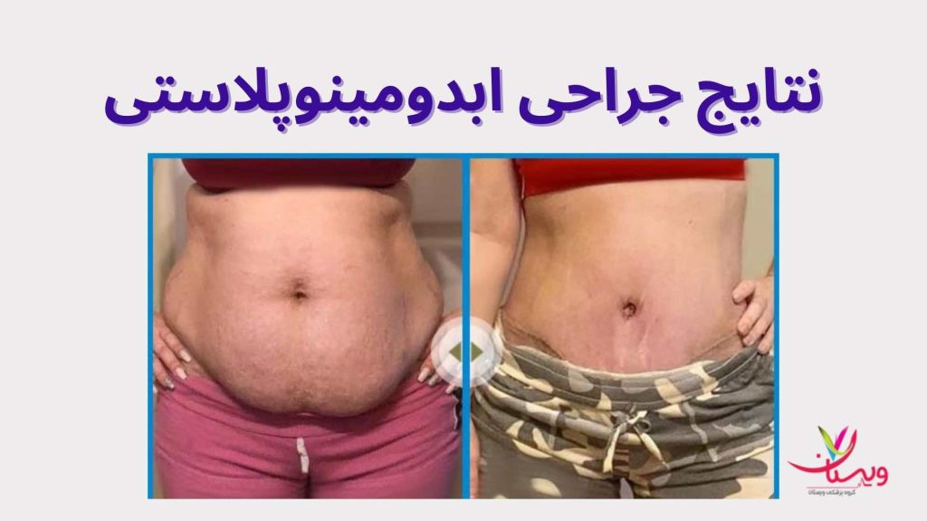 جراحی ابدومینوپلاستی تقویت عضلات شکم