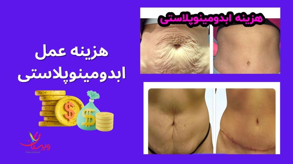 مراقبتهای نقاهت هزینه ابدومینوپلاستی