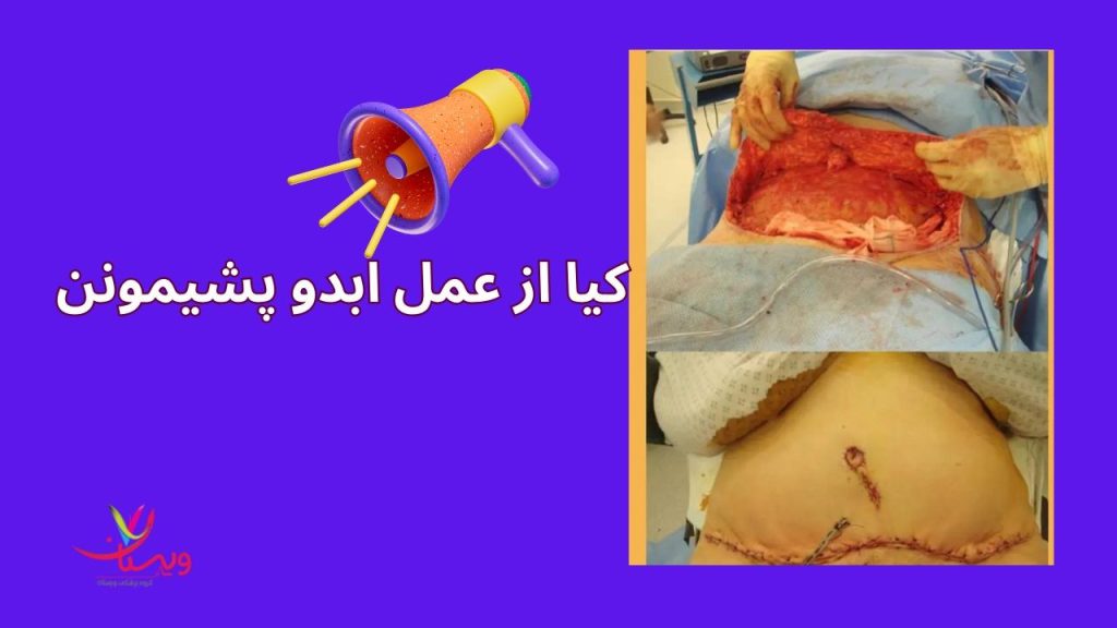 کیا از عمل ابدو پشیمونن