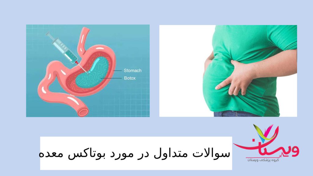 جواب سوالات شما در مورد لاغری با بوتاکس معده مرد چاقی که می خواهد با بوتاکس معده لاغر شود