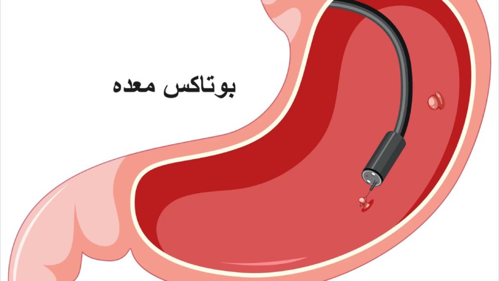 تزریق بوتاکس برای لاغری حدود 30 دقیقه زمان می برد معده ای که دارد با اندوسکوپی تزریق بوتاکس می شود