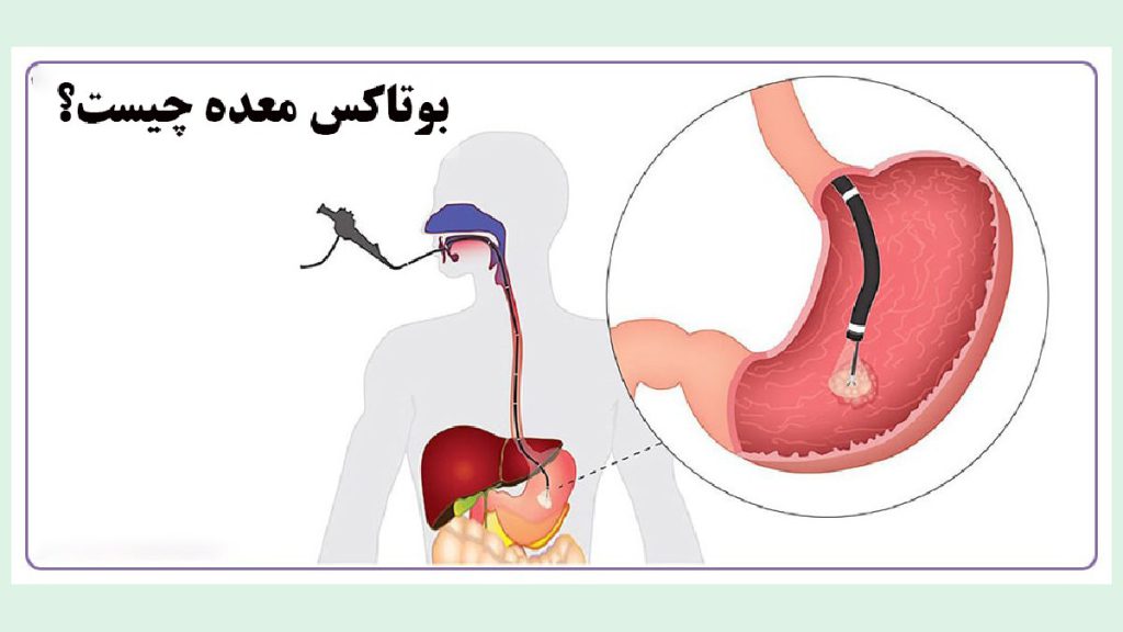 بوتاکس معده چیست؟