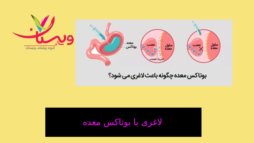 تزریق بوتاکس معده برای لاغری مراحل تزریق بوتاکس برای معده