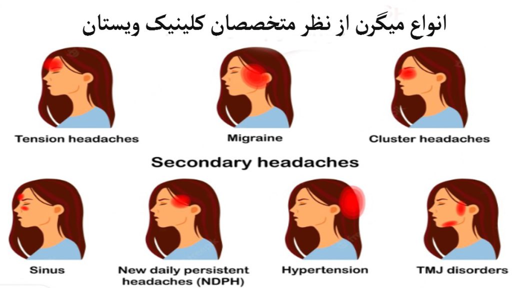 انواع میگرن چند تصویر در یک قاب سفید از درد در قسمتهای مختلف سر برای نمایش انواع میگرن