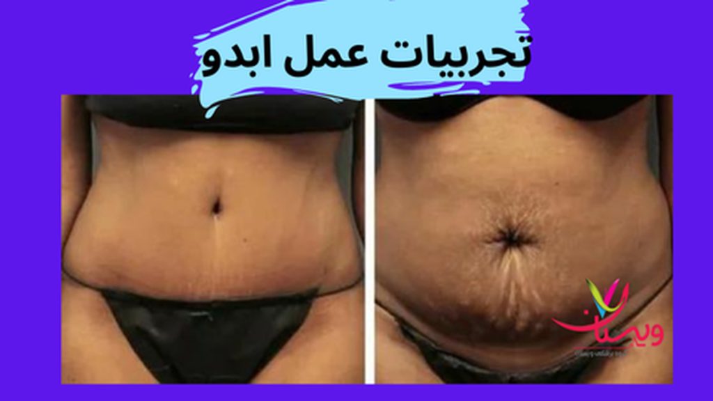 سفت شدن عضلات شکم تجربیات عمل ابدو