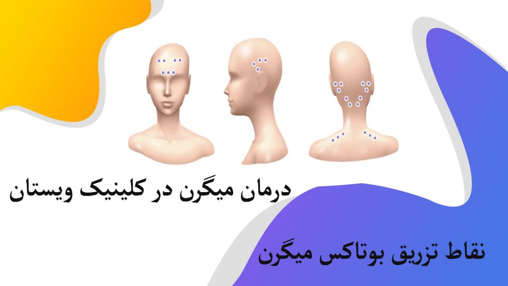چند عکس از مولاژ سر برای نمایش نقاط تزریق بوتاکس میگرن