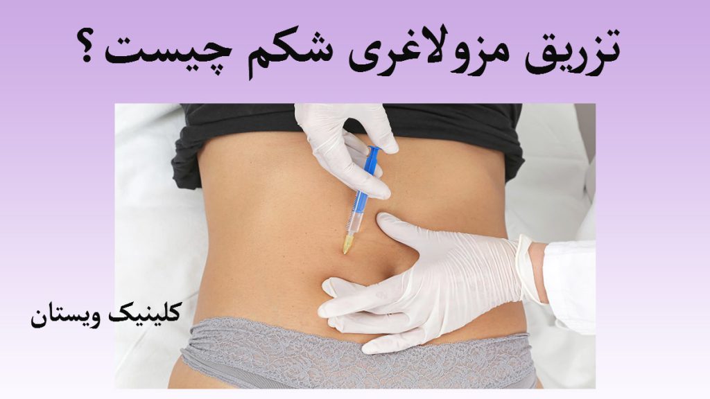تزریق مزولاغری شکم پزشک در حال تزریق به شکم بیمار
