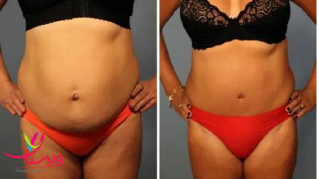 سفت کردن عضلات شکم رضایت از عمل ابدومینوپلاستی