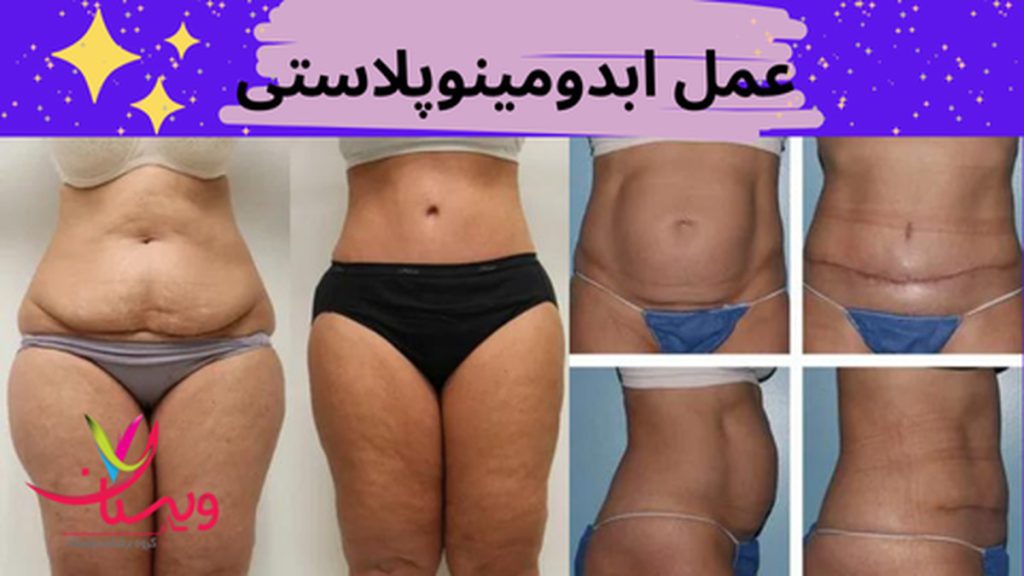 بهبود شکل و ظاهر شکم عمل ابدو چیست