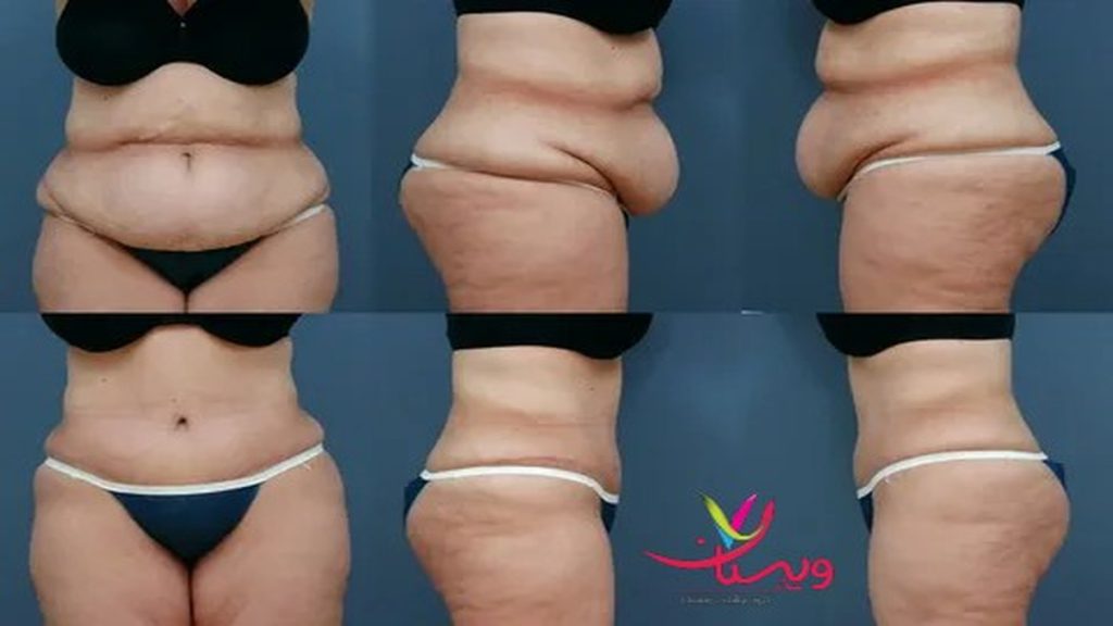 عوارض شایع بعد از عمل ابدو عوارض عمل ابدو