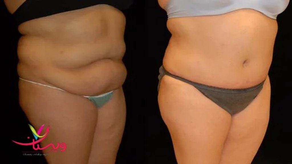 عمل ابدومینوپلاستی عکس بعد از عمل ابدو
