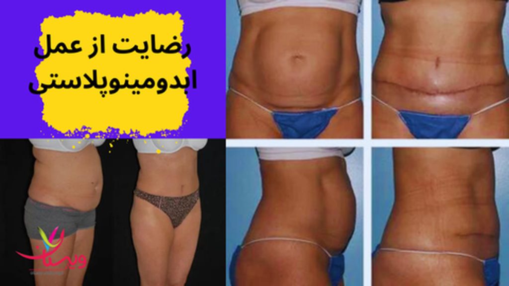 رضایت از عمل ابدومینوپلاستی
