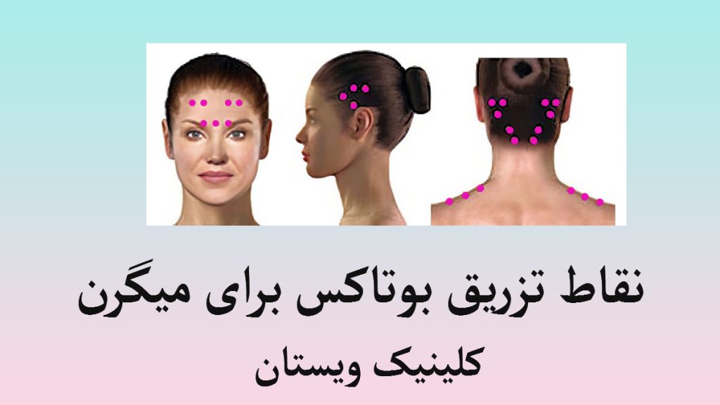 نقاط تزریق بوتاکس میگرن بر روی سر و گردن یک خانم در سه تصویر نقاط تزریق بوتاکس مشخص شده است