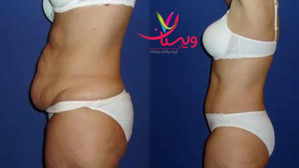 عضلات شکم پمپ درد بعد از عمل ابدومینوپلاستی