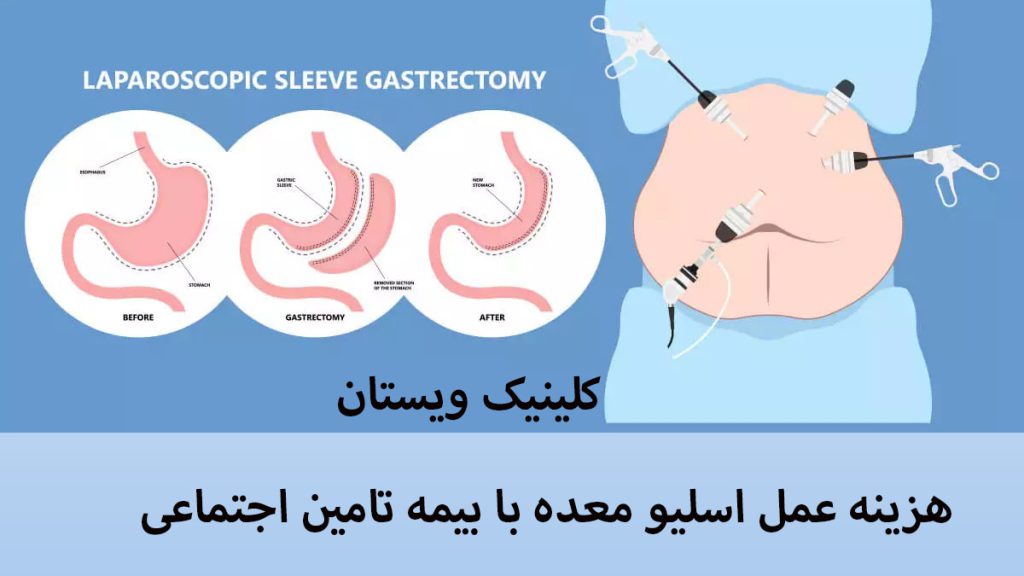 اسلیو معده با بیمه شکم یک شخص در حال انجام اسلیو معده