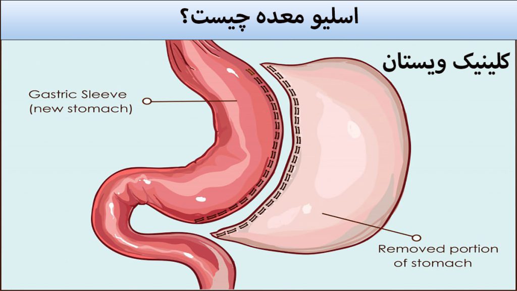 عمل اسلیو معده اسلیو معده در تصویری انیمیشنی نشان داده می شود
