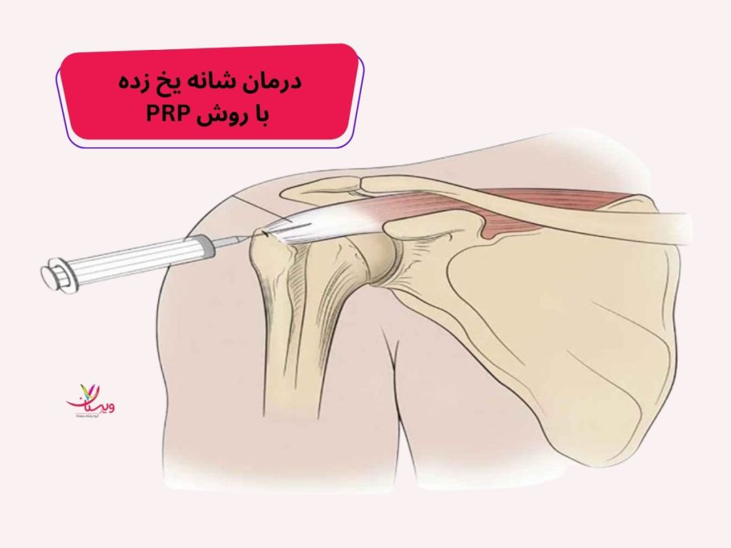 درمان شانه یخ زده درمان شانه یخ زده با روش PRP