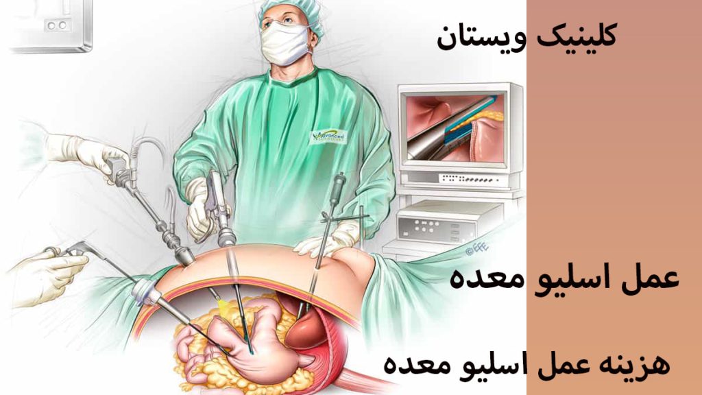 تصویری انیمیشنی از یک پزشک در حال اسلیو معده - هزینه عمل اسلیو معده