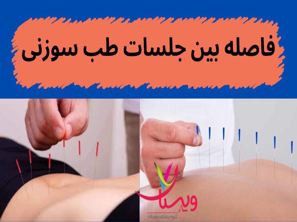 جلسات طب سوزنی فاصله بین جلسات طب سوزنی