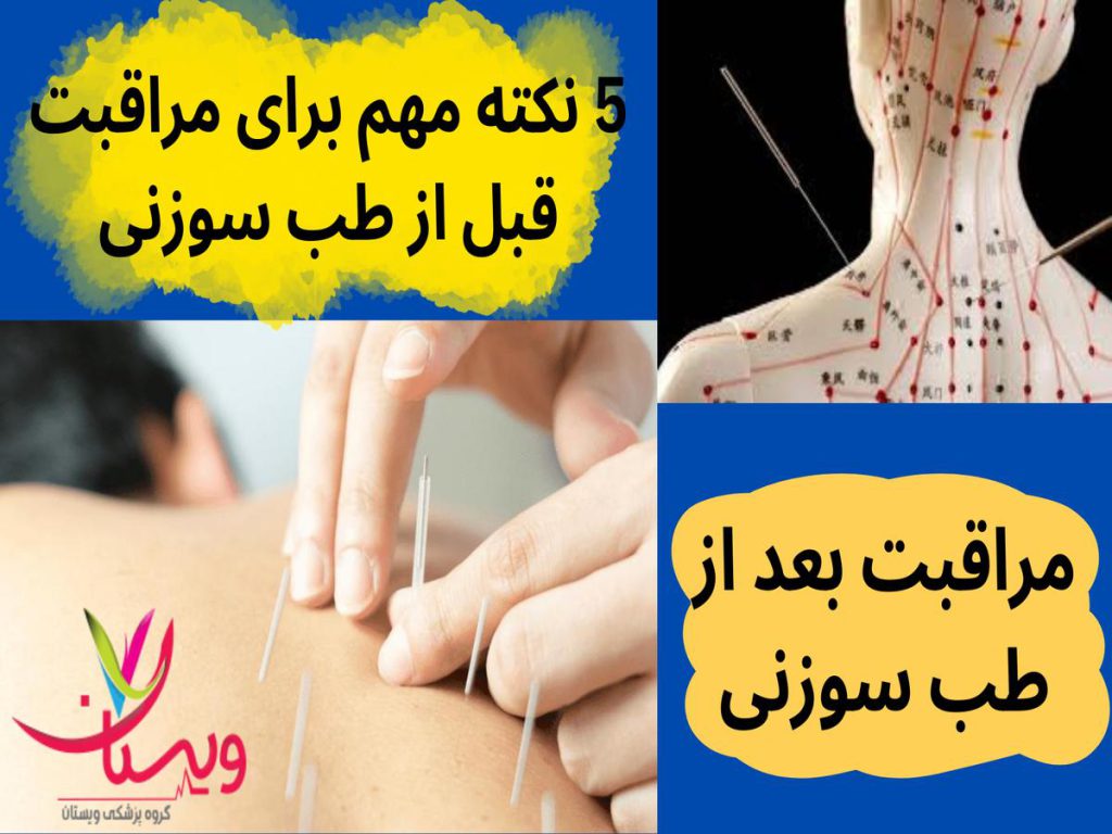مراقبت بعد از طب سوزنی