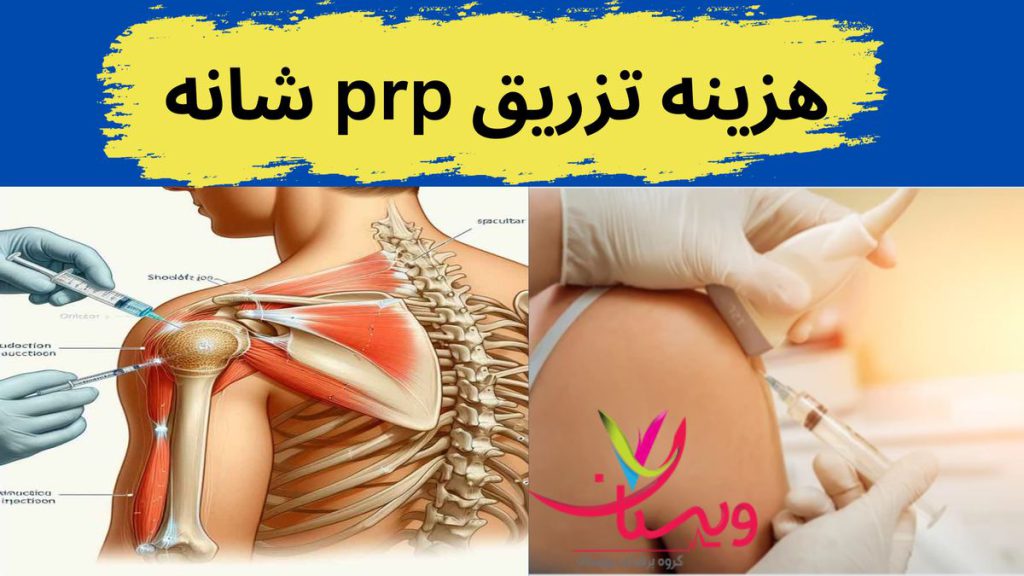 هزینه تزریق پی آر پی هزینه تزریق prp شانه