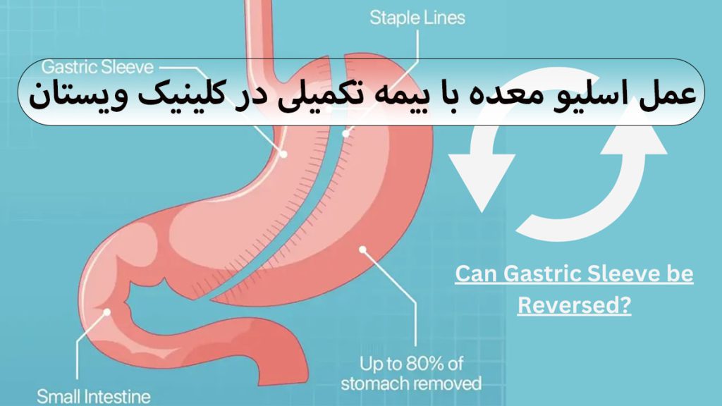 اسلیو معده تامین اجتماعی یک معده که با عمل اسلیو حجم آن کم شده است