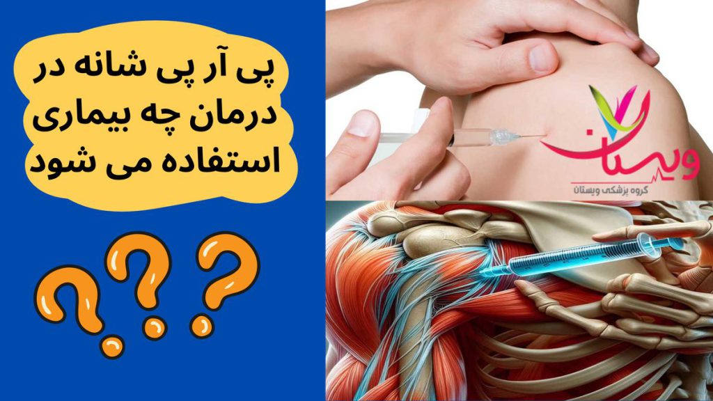پی آر پی شانه پی آر پی شانه در درمان چه بیماری استفاده می شود
