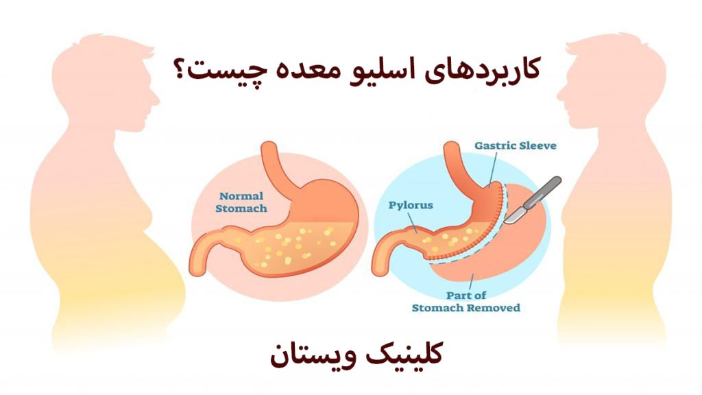کاربردهای اسلیو معده دو شخص به همراه معده قبل و بعد از عمل اسلیو