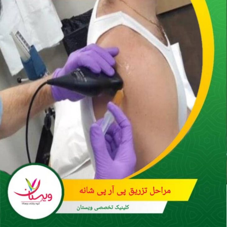 بعد از تزریق، ناحیه شانه با باند یا کمپرس خنک محافظت میشود. توضیح دقیق مراحل تزریق پی آر پی شانه