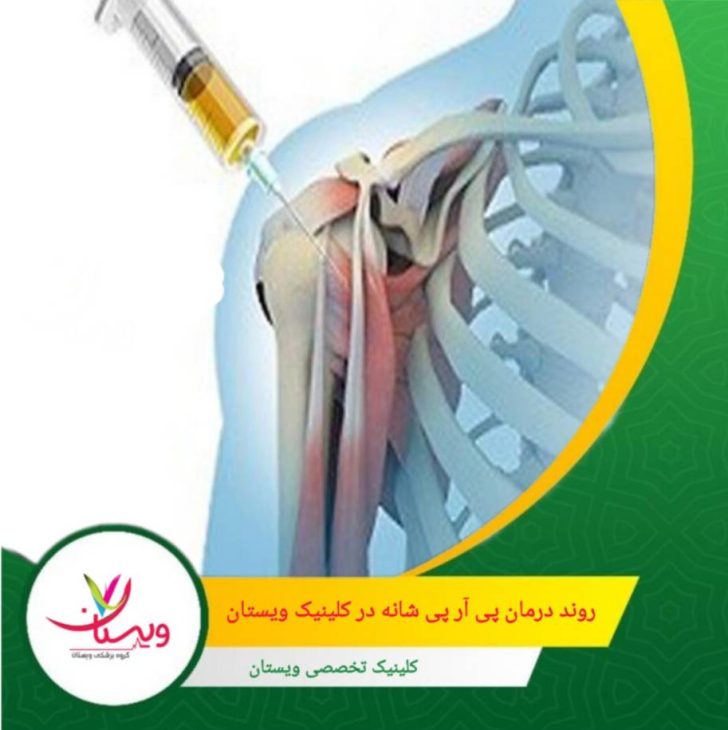معمولاً ۲ تا ۴ جلسه با فاصله ۲ تا ۴ هفته برای رسیدن به نتیجه مطلوب توصیه میشود. نتایج اولیه معمولاً بعد از ۲ هفته قابل مشاهده است. روند درمان پی آر پی شانه در کلینیک ویستان