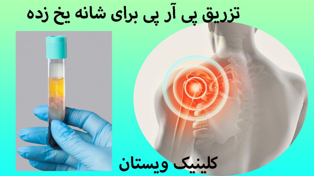 تزریق PRP برای شانه یخ زده یک تصویر از پی ار پی و یک تزریق دیگر از درد شانه