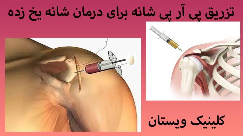 دو تصویر از تزریق prp شانه در یک قاب