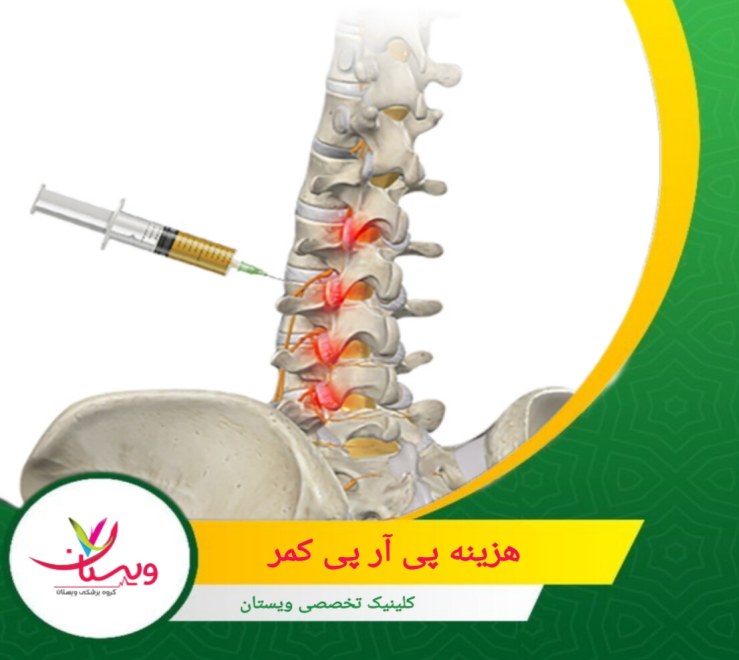 هزینه پی آر پی کمر