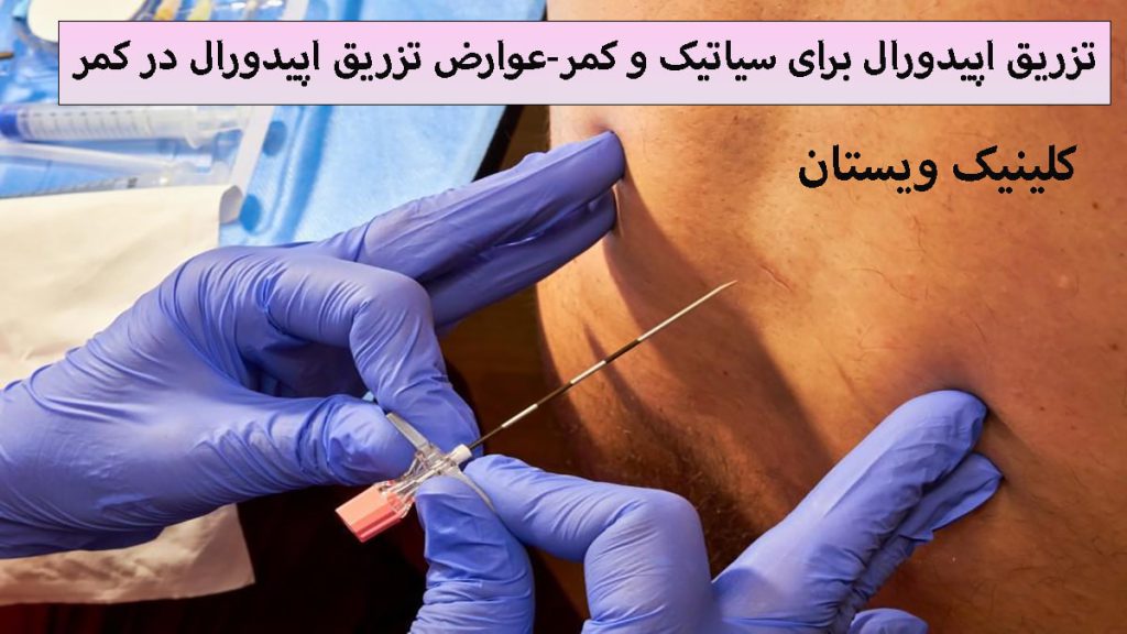 پزشک در حال تزریق اپیدورال به کمر