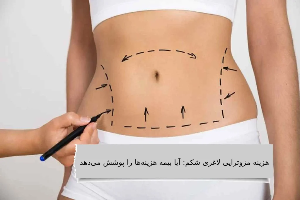 هزینه مزوتراپی لاغری شکم: آیا بیمه هزینه هارا پوشش میدهد؟ هزینه مزوتراپی شکم