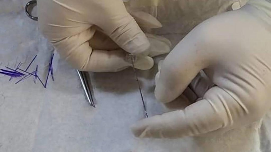 مزو امبدینگ لاغری