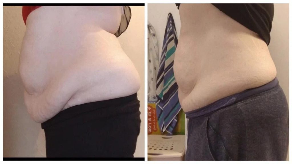 مزو امبدینگ برای کاهش سایز شکم و پهلو