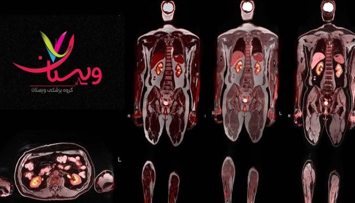 تصاویری از اسکن هسته ای سرطان در کلینیک ویستان