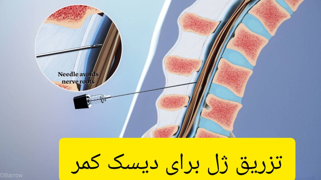 نمادی از تزریق ژل به کمر نمادی از کمر بیمار و تزریق ژل برای دیسک کمر