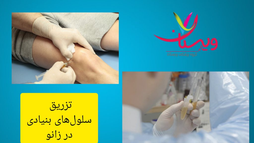روش مدرن درمان زانو با سلول های بنیادی تزریق سلولهای بنیادی در زانوی بیمار توسط پزشک