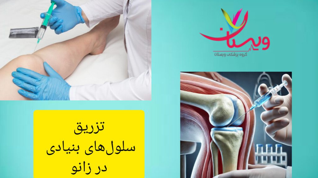 تزریق سلولهای بنیادی، امیدی برای بیماران زانو درد بیمار در حال دریافت درمان با سلول های بنیادی برای زانو