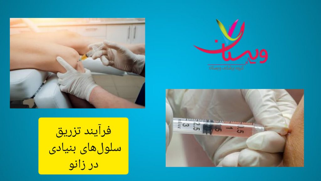 کاهش التهاب زانو با تکنولوژی سلول های بنیادی بیمار درمان با تزریق سلول های بنیادی را دریافت می کند