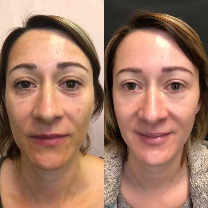 تاثیر پی ار پی بر جوانسازی پوست